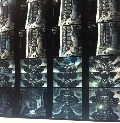 腰椎压迫神经腿疼腿麻怎么办 营养神经的药有