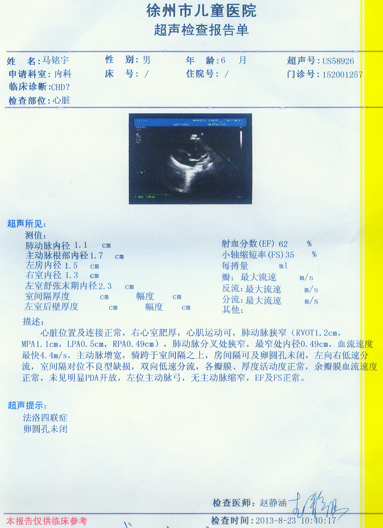 所患疾病:法四、卵圆孔未闭 病情描述:宝宝6个月,最近咳嗽感冒,医生听诊说心脏有杂音,做了心脏彩超说是法四、卵圆孔未闭。宝宝平时不太哭闹,但是也挺活泼,偶尔哭闹时发现嘴唇青紫、脚板发紫(以前发现没往这方面想),吃奶易出汗,躺着的时候爱来回翻动,睡觉时爱左侧睡。 8月23日做心脏彩超说是法四、卵圆孔未闭,未进行治疗。 请问可以手术治疗吗,治疗效果如何?术前需要注意哪些吗,最近想等宝宝感冒咳嗽好了去做手术,请问预约您的门诊大概什么时间能够进行治疗?