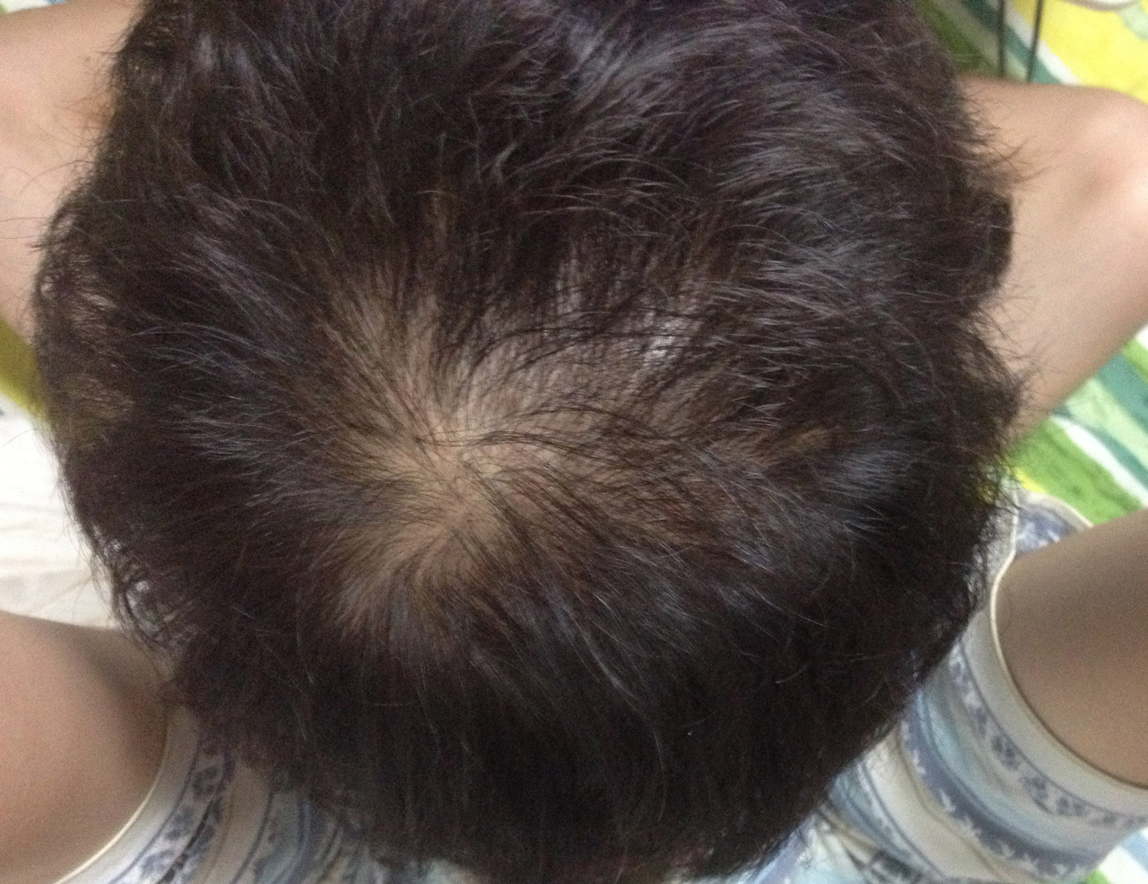 13年脱发症状该如何医治 如何再让<em>头发</em>变得茂