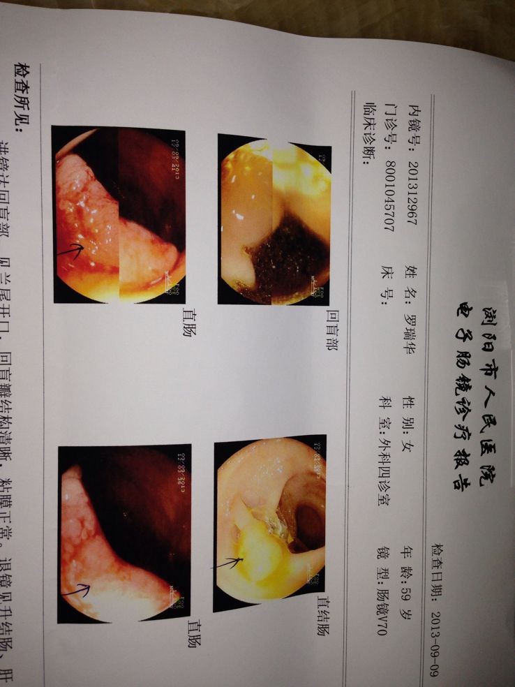 直肠癌,想实施保肛手术_中国医学科学院肿瘤医院吴铁成