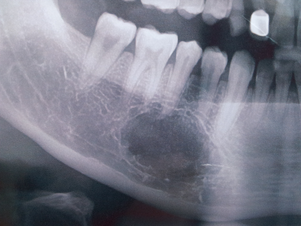 牙根部有椭圆的阴影,是囊肿还是骨质瘤,需要手术吗?
