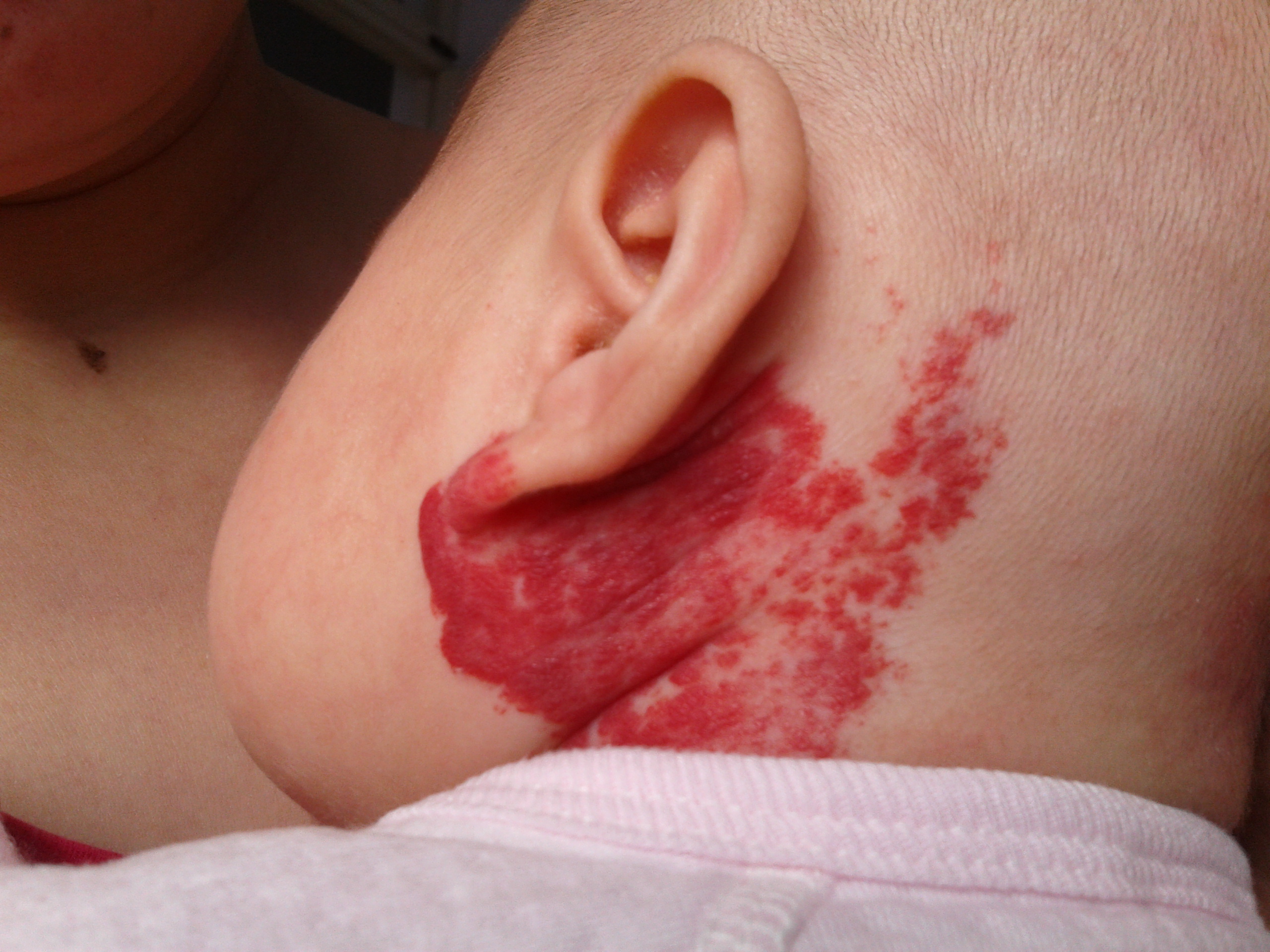 后变大,变红,变深,在当地医院诊断为血管瘤,可能是草莓状毛细血管瘤