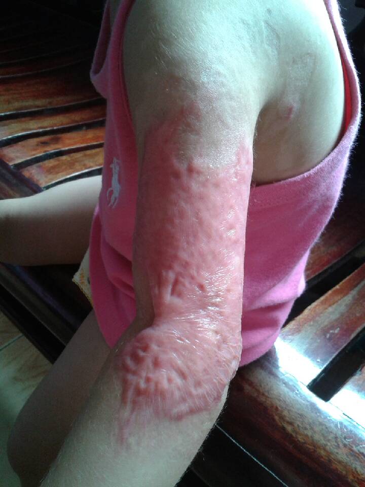 但前提是肉要变色,现在是红红的,当时医生也没说要去烫伤科再看看.