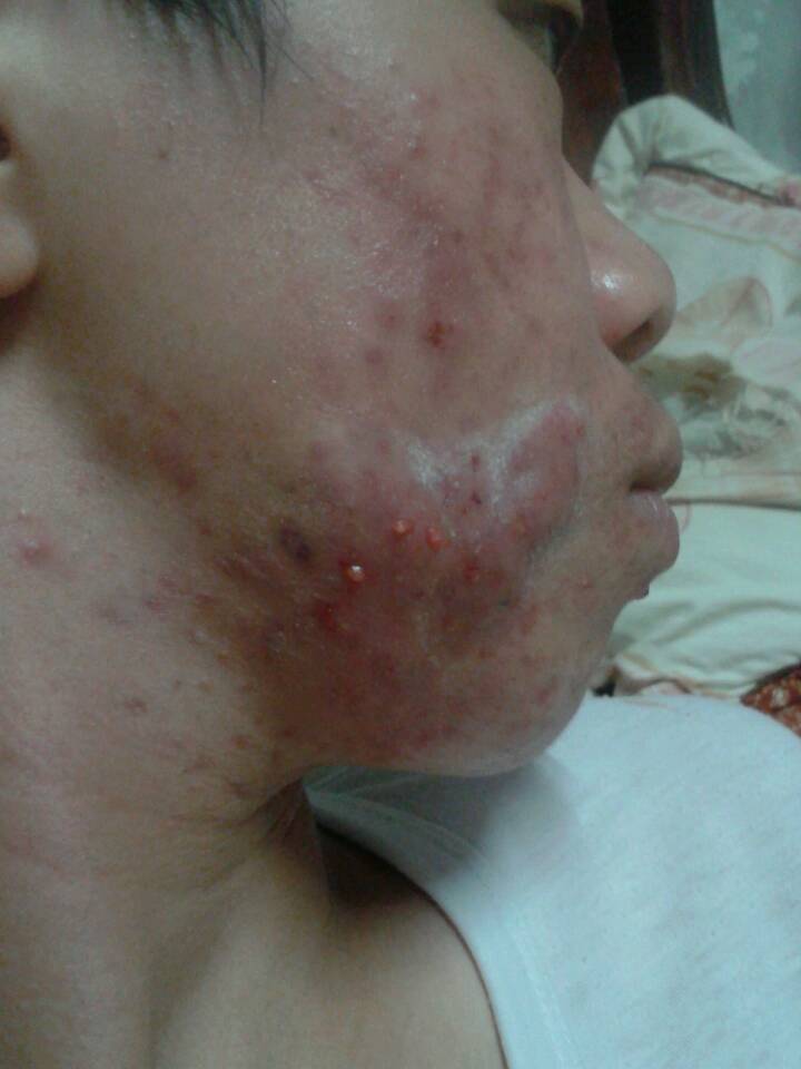 18岁男孩脸上长满青春痘,毛孔一直流出血