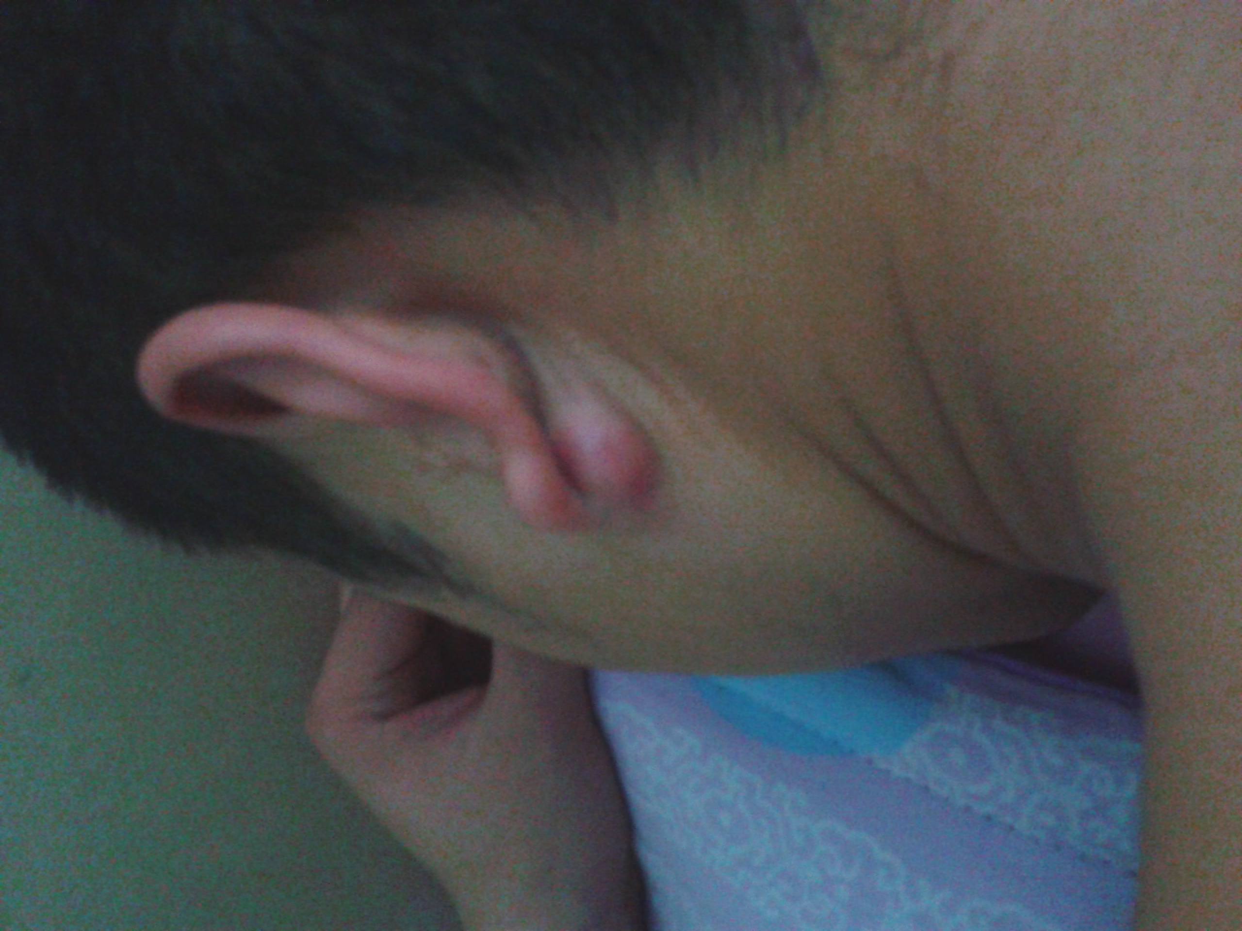 问题:耳后皮脂腺囊肿,双耳都有,一侧已经感染化脓