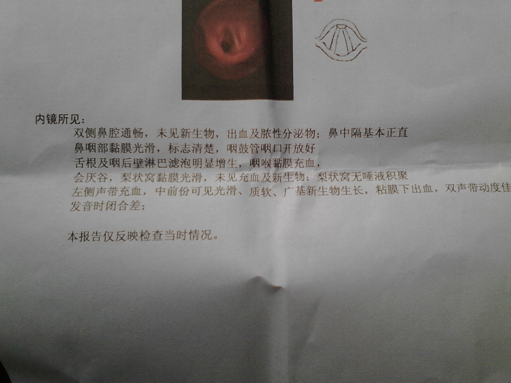 问题:声带息肉手术是否采用纤维喉镜切除手术