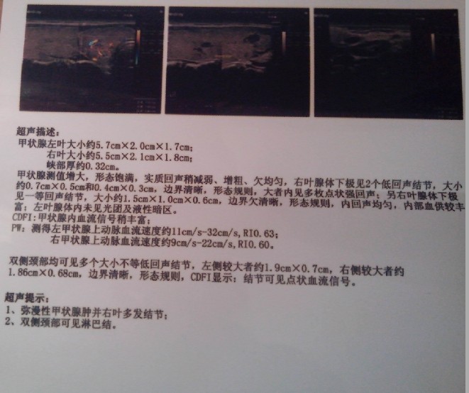 甲状腺多发性结节是否要手术,术后会有何不良