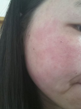 问题:脸颊两边总是红红的,像过敏一样