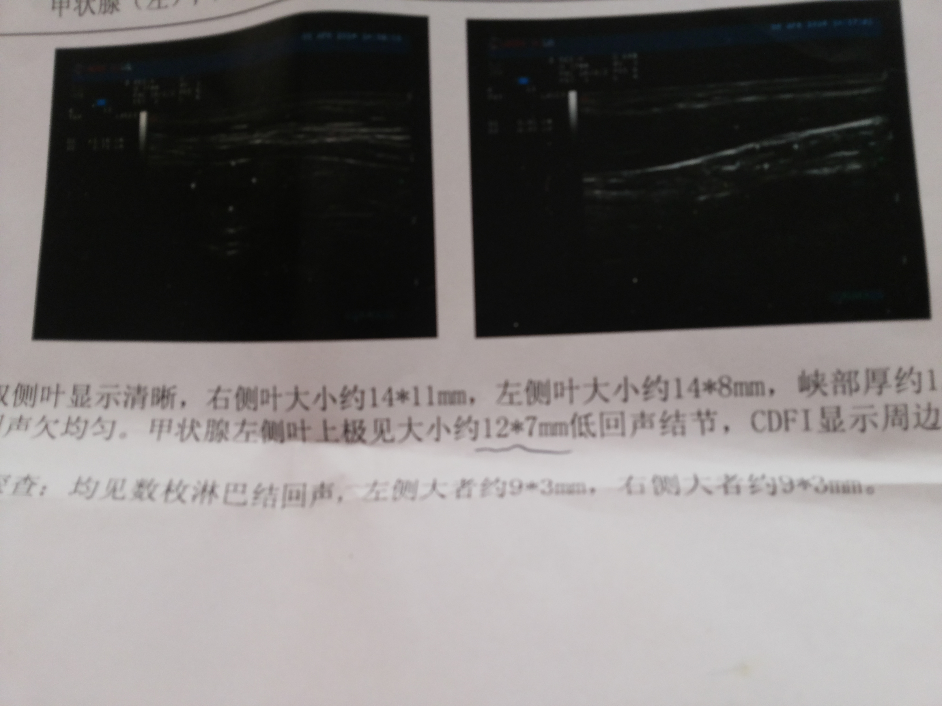 甲状腺左侧叶上极见大小约12*7mm低回声结节,cdfi显示周边半环绕血流