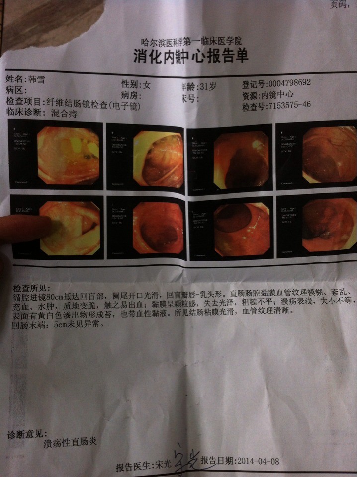 问题:溃疡性直肠炎的治疗