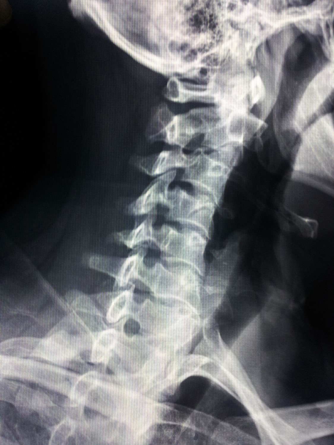 左侧手臂麻木。去医院拍了片子。说是颈椎病