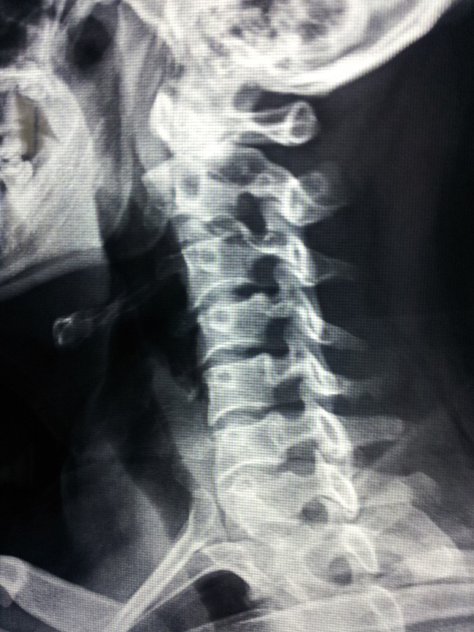 左侧手臂麻木。去医院拍了片子。说是颈椎病