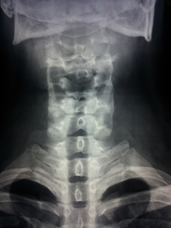 左侧手臂麻木。去医院拍了片子。说是颈椎病