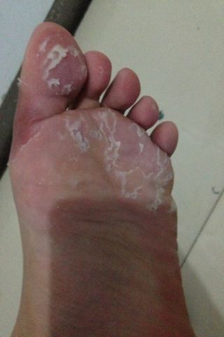 问题:化验过 是真菌感染 脚趾间皮肤